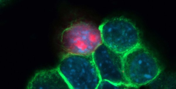 Ultrasound Can Selectively Kill Cancer Cells Medical Engineering Ultrasound Can Selectively Kill Cancer Cells Medical Engineering